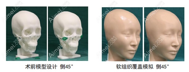 3d打印人工骨怎么修复被切掉的下颌角 3d打印人工骨怎么修复被切掉的下颌角