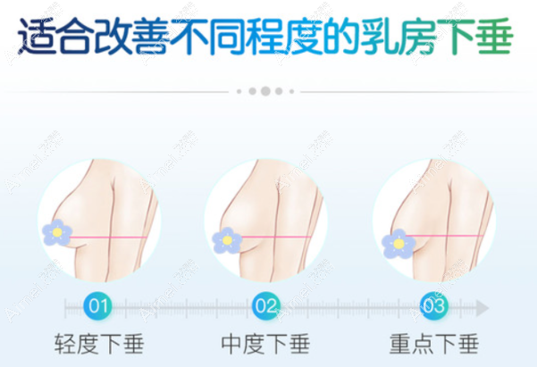 乳房下垂上提手术大约多少钱?假体隆胸矫正胸下垂价格2万+