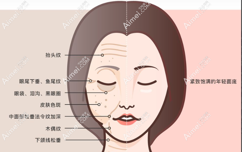 拉皮手术后遗症太大,拉皮亲身经历40天后悔了感觉自己好丑