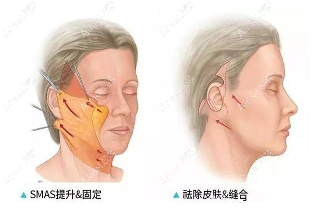 拉皮手术的切口部位和术后疗效