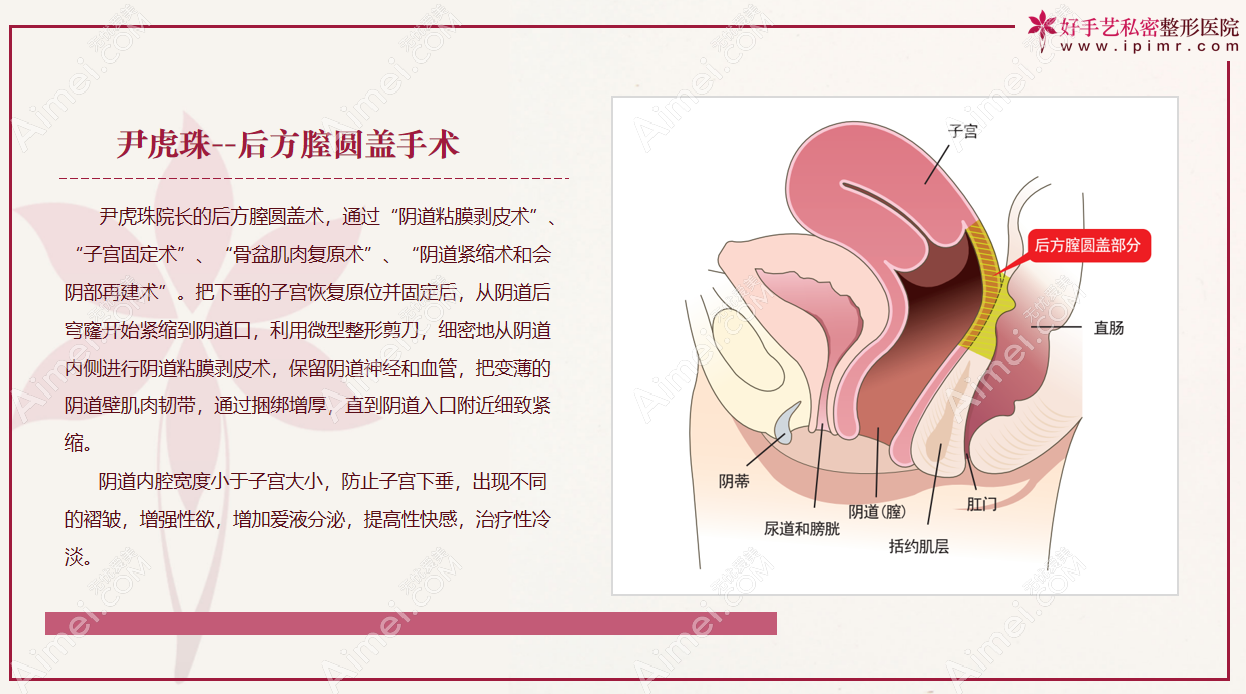 韩国好手艺医院特色手术是后方膣圆盖阴道紧缩术 韩国好手艺医院特色手术是后方膣圆盖阴道紧缩术