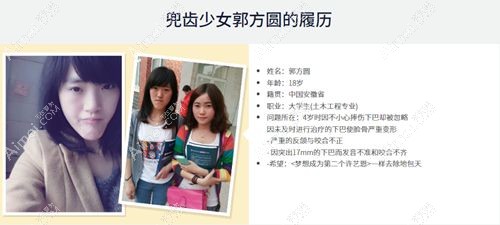 《let美人》郭方圆面部轮廓整形前照片.jpg 《let美人》郭方圆面部轮廓整形前照片.jpg