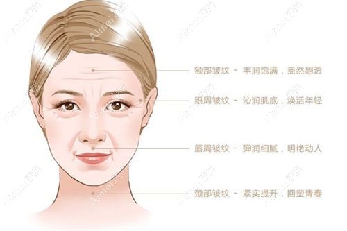 深圳玻尿酸注射好的医生排名:排前一的陈瑞红技术好很出名