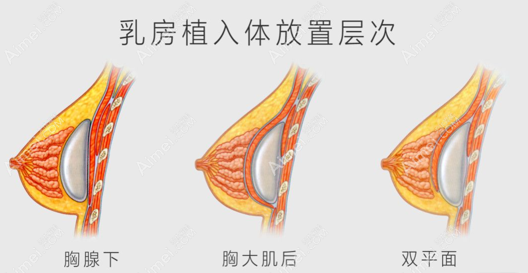 假体隆胸大力压会移位但不会被打出来 假体隆胸大力压会移位但不会被打出来