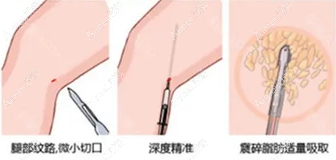 王世虎医生做吸脂修复过程 王世虎医生做吸脂修复过程
