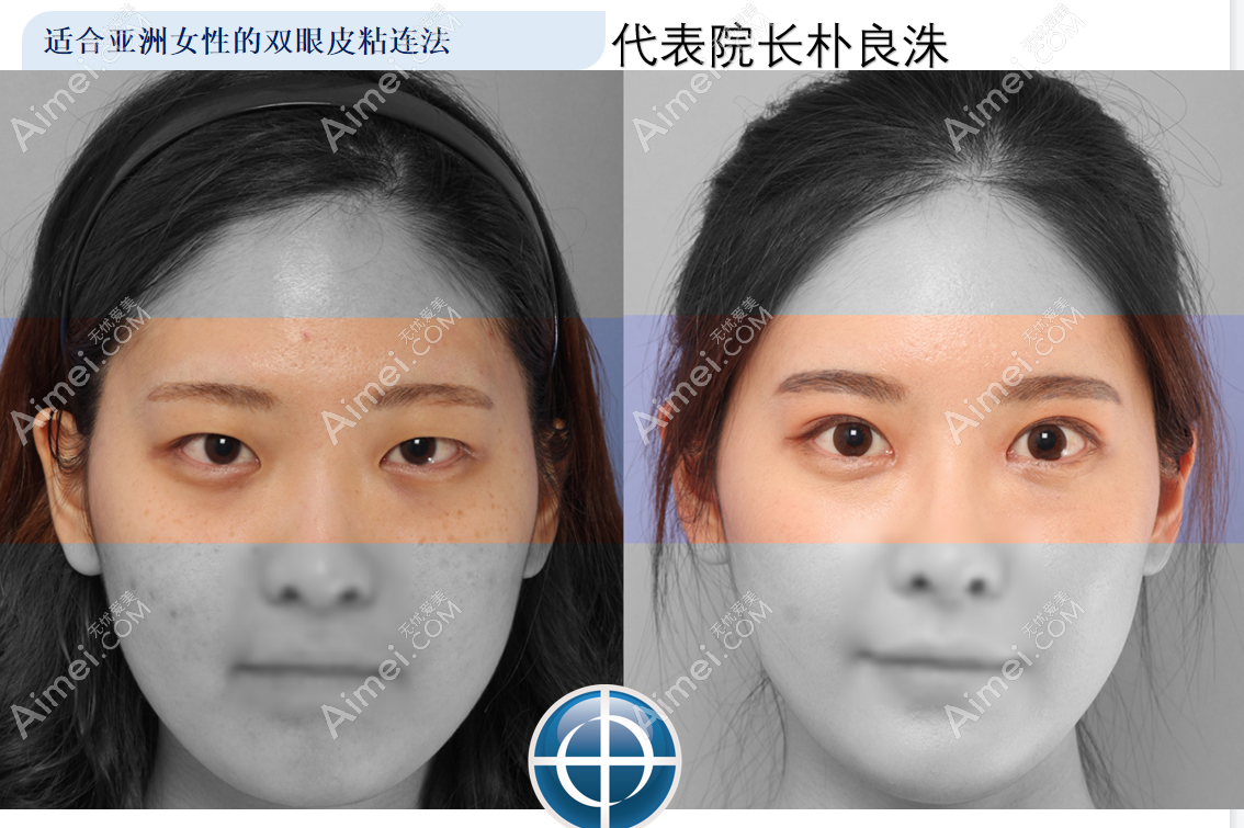 韩国梦想整形医院朴良洙院长眼综合前后对比照片