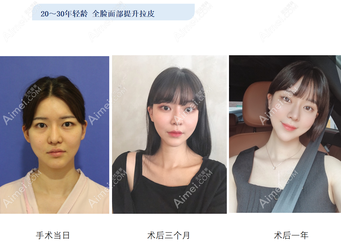 韩国梦想整形医院柳垣在院长全脸面部拉皮提升一年对比图
