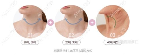 韩国延世多仁整形外科去颈纹手术详解.jpg 韩国延世多仁整形外科去颈纹手术详解.jpg