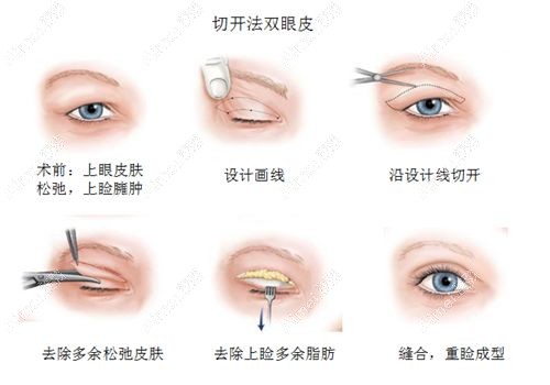 福州海峡李丽强割双眼皮好吗.jpg 福州海峡李丽强割双眼皮好吗.jpg