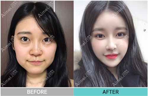 珠儿丽整形外科隆鼻例子.jpg 珠儿丽整形外科隆鼻例子.jpg