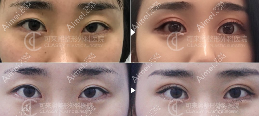 韩国可来熙整形医院双眼皮修复怎么样 韩国可来熙整形医院双眼皮修复怎么样