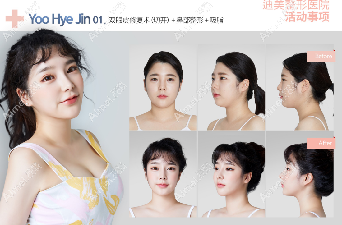 韩国迪美整形医院双眼皮修复+鼻综合+腰腹大腿吸脂前后对比照片 韩国迪美整形医院双眼皮修复+鼻综合+腰腹大腿吸脂前后对比照片