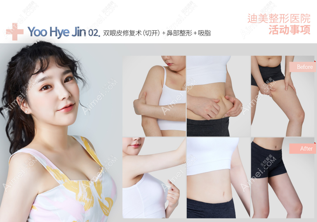 韩国迪美整形医院双眼皮修复+鼻综合+腰腹大腿吸脂前后对比照片 韩国迪美整形医院双眼皮修复+鼻综合+腰腹大腿吸脂前后对比照片