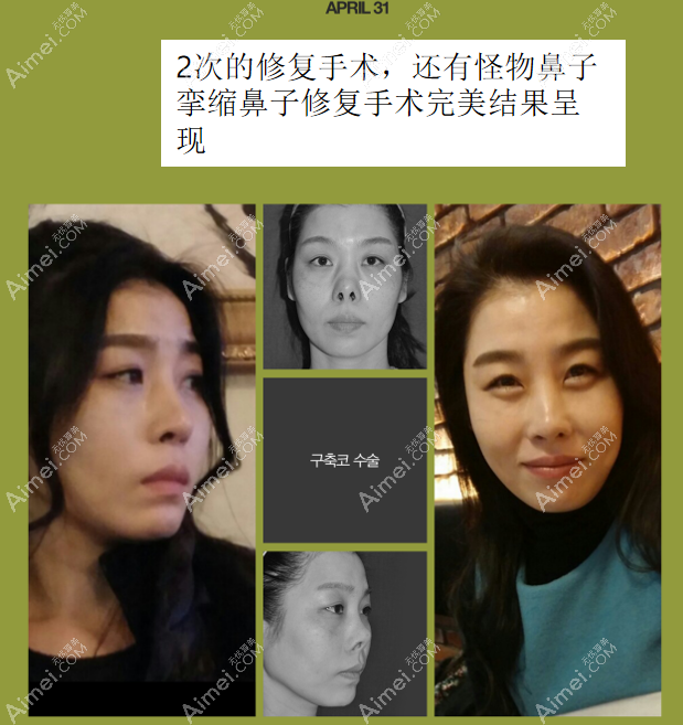 韩国431整形医院金载勋医生挛缩鼻修复前后对比照片 韩国431整形医院金载勋医生挛缩鼻修复前后对比照片