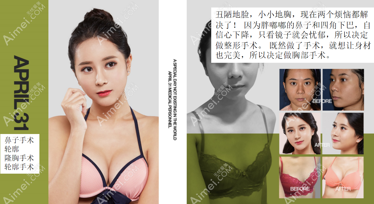 韩国431医院面部轮廓磨骨+隆胸+鼻综合隆鼻真人照片 韩国431医院面部轮廓磨骨+隆胸+鼻综合隆鼻真人照片
