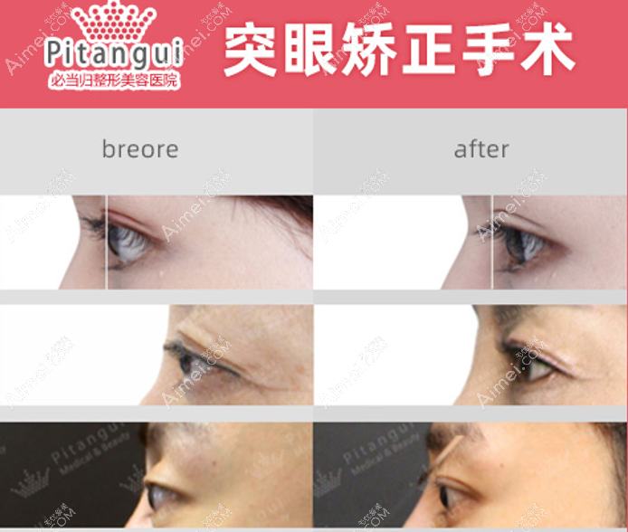 韩国必当归的柳济圣院长突眼修复实例 韩国必当归的柳济圣院长突眼修复实例