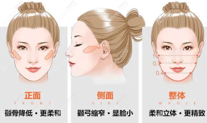 韩国伊美芝整形颌面轮廓怎么样 韩国伊美芝整形颌面轮廓怎么样