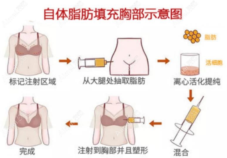 成都恒博天姿整形做脂肪丰胸好吗 成都恒博天姿整形做脂肪丰胸好吗
