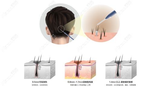 韩国植发手术价格表参考了毛杰琳植发收费www.dlren.com.jpg 韩国植发手术价格表参考了毛杰琳植发收费www.dlren.com.jpg