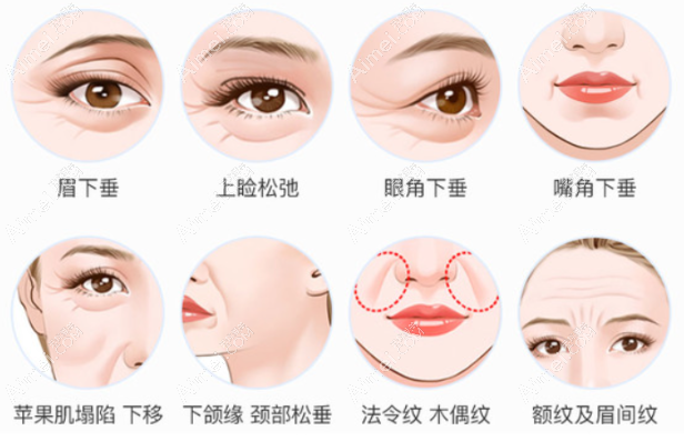 李晓东医生PSV和PST面部提升区别 李晓东医生PSV和PST面部提升区别