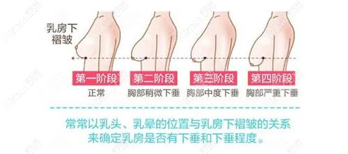 乳房下垂做人工韧带提升和双环悬吊的区别分析m.dlren.com.jpg 乳房下垂做人工韧带提升和双环悬吊的区别分析m.dlren.com.jpg