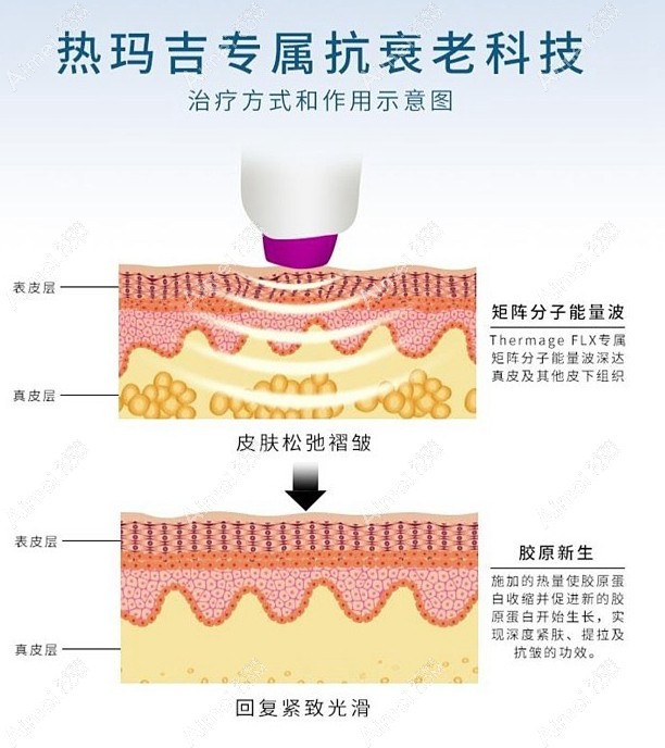 热玛吉治疗原理及层次 热玛吉治疗原理及层次