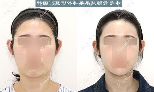 林宗宇院长做三角颧骨缩小手术前后对比图.jpg 林宗宇院长做三角颧骨缩小手术前后对比图.jpg