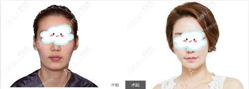 智龙薰院长做三角颧骨缩小手术前后对比图m.dlren.com.jpg 智龙薰院长做三角颧骨缩小手术前后对比图m.dlren.com.jpg