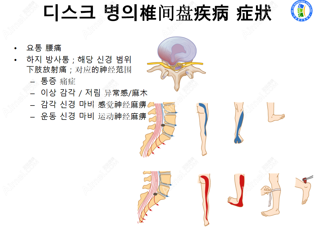 韩国李承哲神经外科颈椎病治疗价格表 韩国李承哲神经外科颈椎病治疗价格表