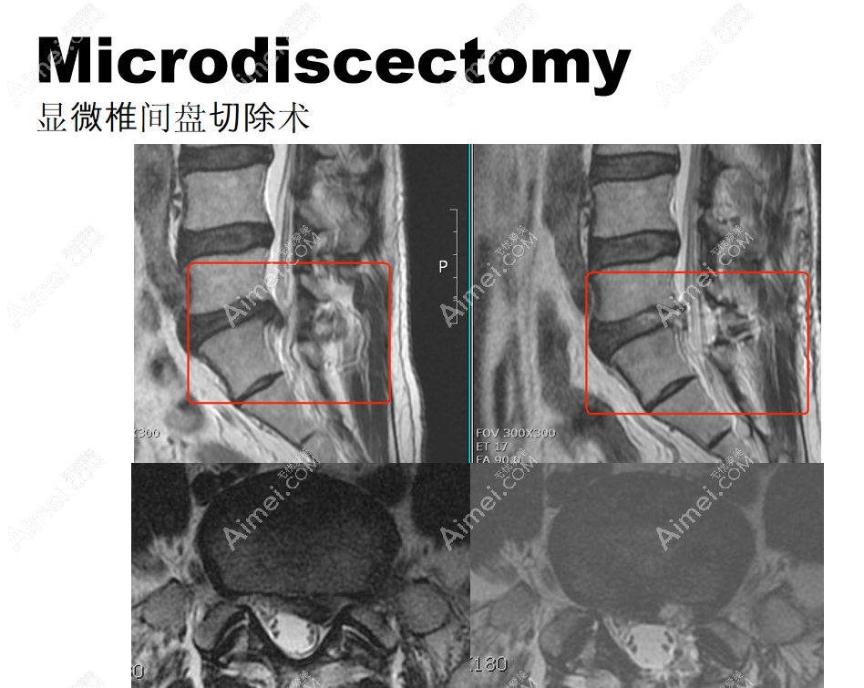 韩国李承哲神经外科腰椎间盘切除前后对比图片 韩国李承哲神经外科腰椎间盘切除前后对比图片