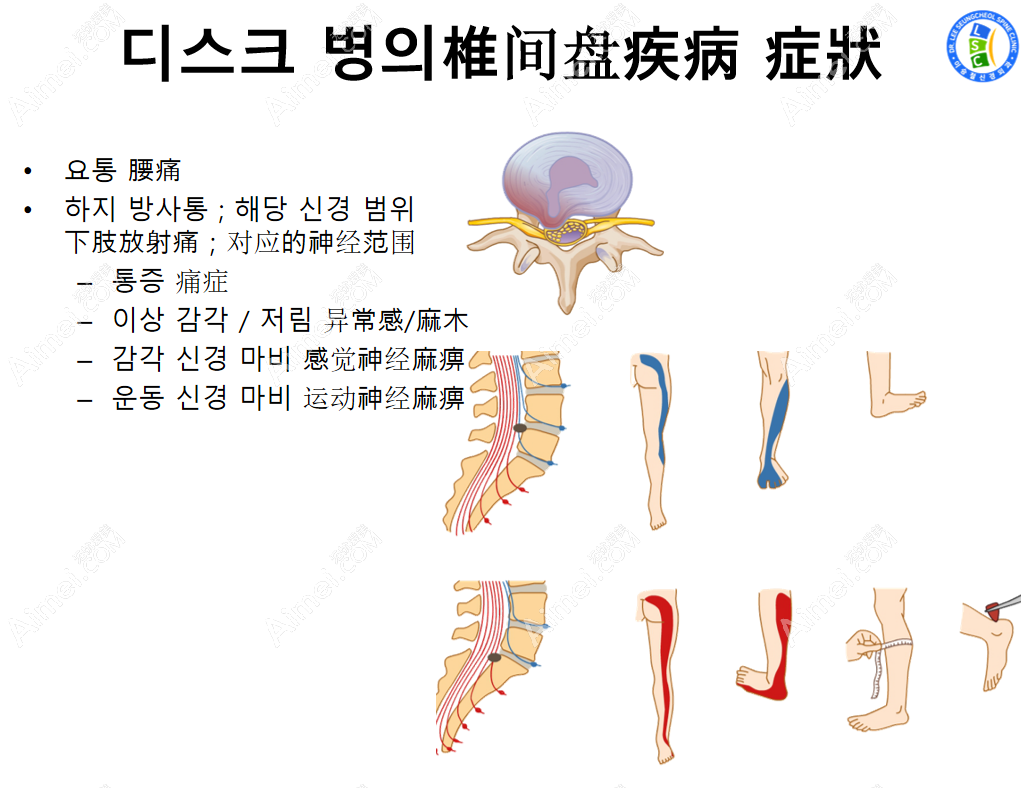 韩国李承哲神经外科医院脊椎病治疗适合人群 韩国李承哲神经外科医院脊椎病治疗适合人群