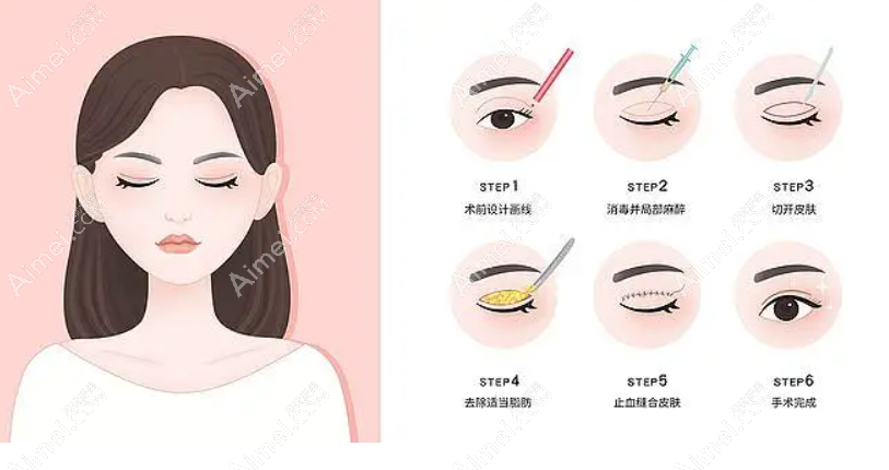 日照壹美天成医院李超院长做眼睛怎么样 日照壹美天成医院李超院长做眼睛怎么样
