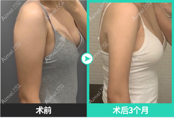 韩国宝士丽整形医院手臂吸脂3个月前后对比照片 韩国宝士丽整形医院手臂吸脂3个月前后对比照片