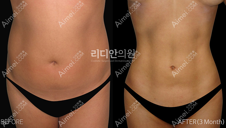 韩国丽迪安女性腰腹抽脂术前和术后3个月对比图 韩国丽迪安女性腰腹抽脂术前和术后3个月对比图