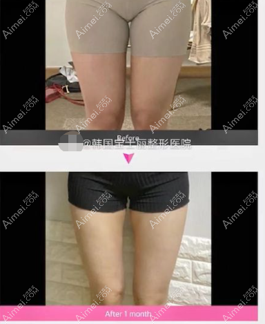 韩国宝士丽整形医院大腿吸脂前后对比照片 韩国宝士丽整形医院大腿吸脂前后对比照片