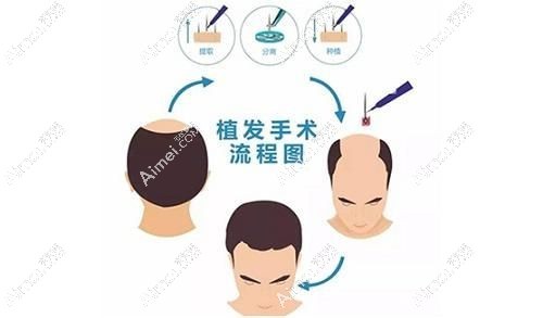 韩国毛发移植手术流程 韩国毛发移植手术流程