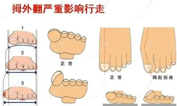 拇外翻后遗症有哪些 拇外翻后遗症有哪些