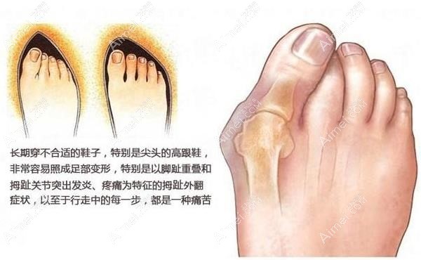 微创拇外翻手术多少钱 dlren.com 微创拇外翻手术多少钱 dlren.com