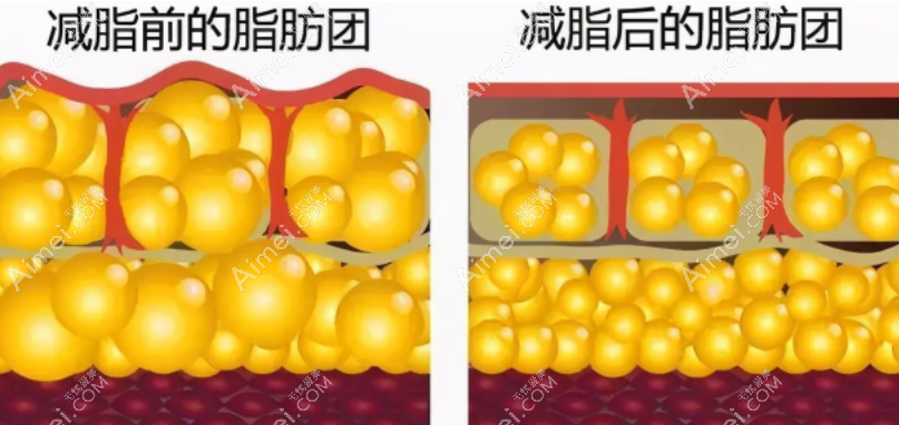 冯斌医生吸脂技术靠谱 冯斌医生吸脂技术靠谱
