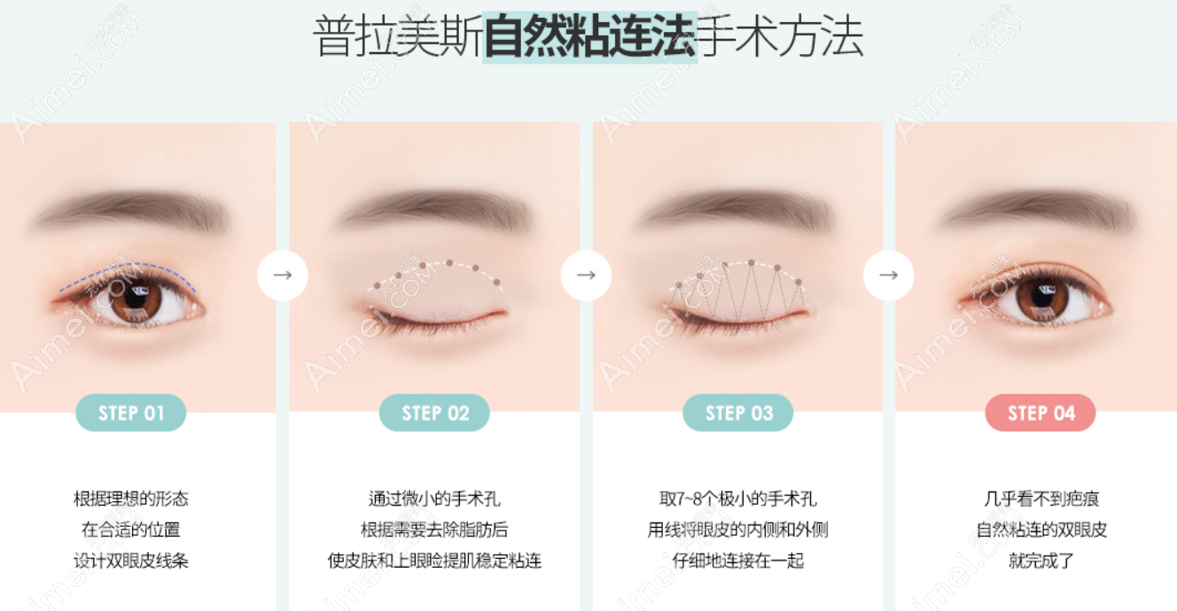 韩国普拉美斯整形自然黏连双眼皮怎么做 韩国普拉美斯整形自然黏连双眼皮怎么做