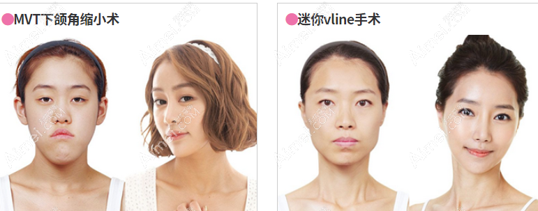 韩国id整形轮廓改脸型前后对比图 韩国id整形轮廓改脸型前后对比图