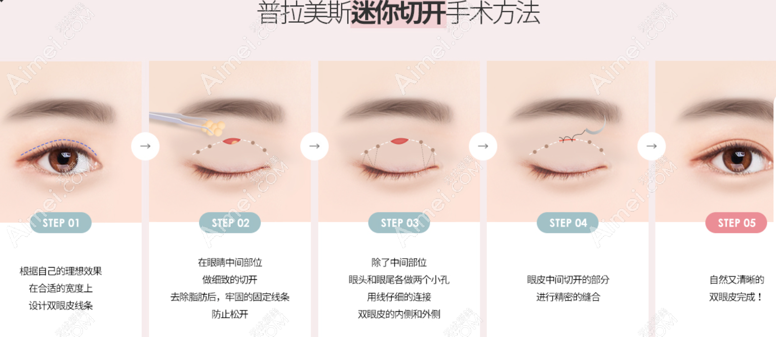 韩国普拉美斯整形外科医院迷你切开双眼皮是怎样做的 韩国普拉美斯整形外科医院迷你切开双眼皮是怎样做的