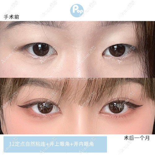 韩国pop整形12点定点自然粘连术 韩国pop整形12点定点自然粘连术