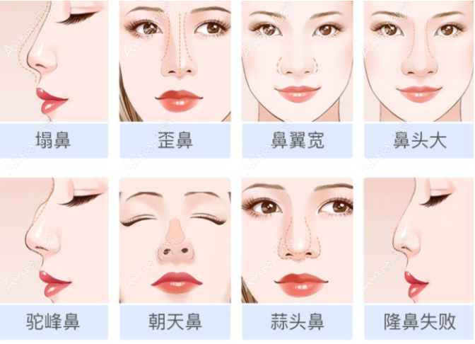 宜春名星整形做鼻子多少钱 宜春名星整形做鼻子多少钱