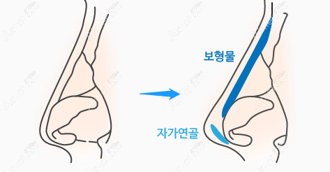 韩国美尔韩鼻综合做得好 韩国美尔韩鼻综合做得好