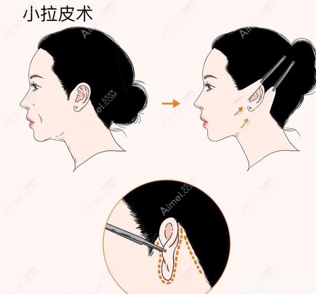 李晓东pst面部提升手术过程www.dlren.com 李晓东pst面部提升手术过程www.dlren.com