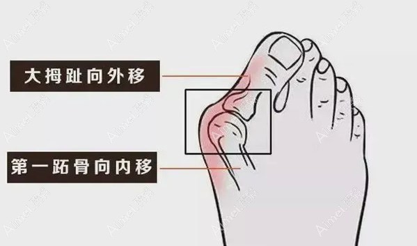 沈阳北方医院做大脚骨微创手术优势m.dlren.com 沈阳北方医院做大脚骨微创手术优势m.dlren.com