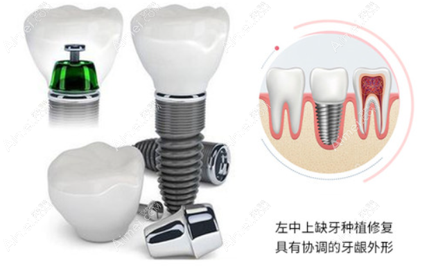 种植牙集采价格多少钱一颗 dlren.com 种植牙集采价格多少钱一颗 dlren.com