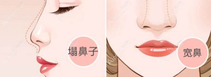 刘凯鼻修复手术后的真实示例 刘凯鼻修复手术后的真实示例