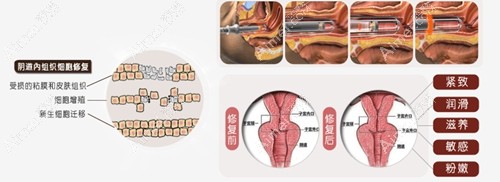 做完紧缩手术后悔死了真实原因www.dlren.com.jpg
